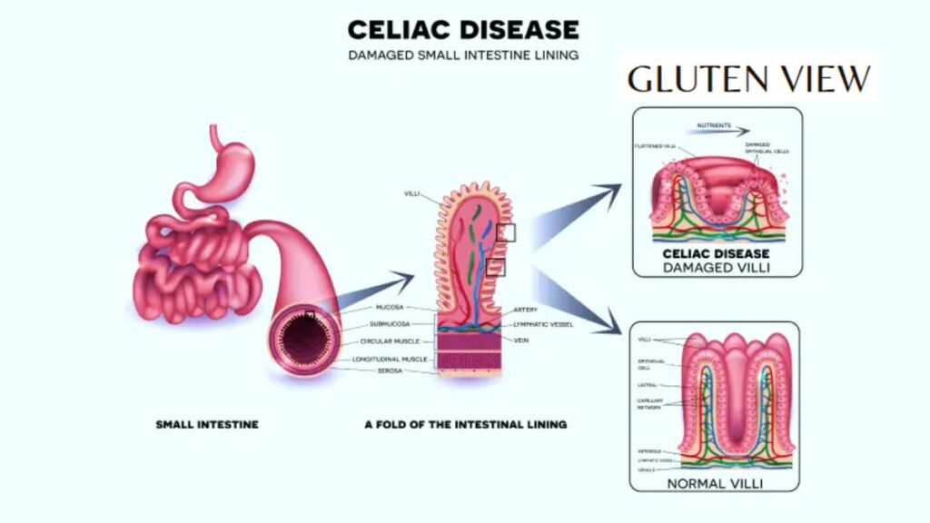 Why Celiac Patients Must Be Extra Careful